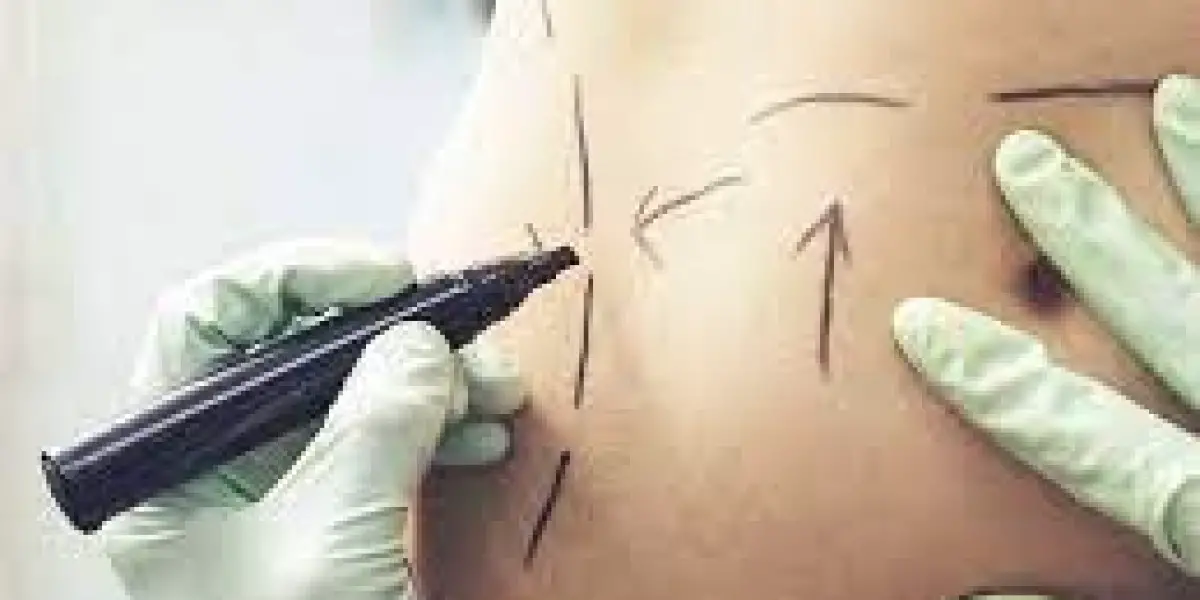 Does Liposuction Remove Fat Forever?