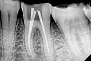 Root Canal Treatment in Ahmedabad | Suman Dental Care