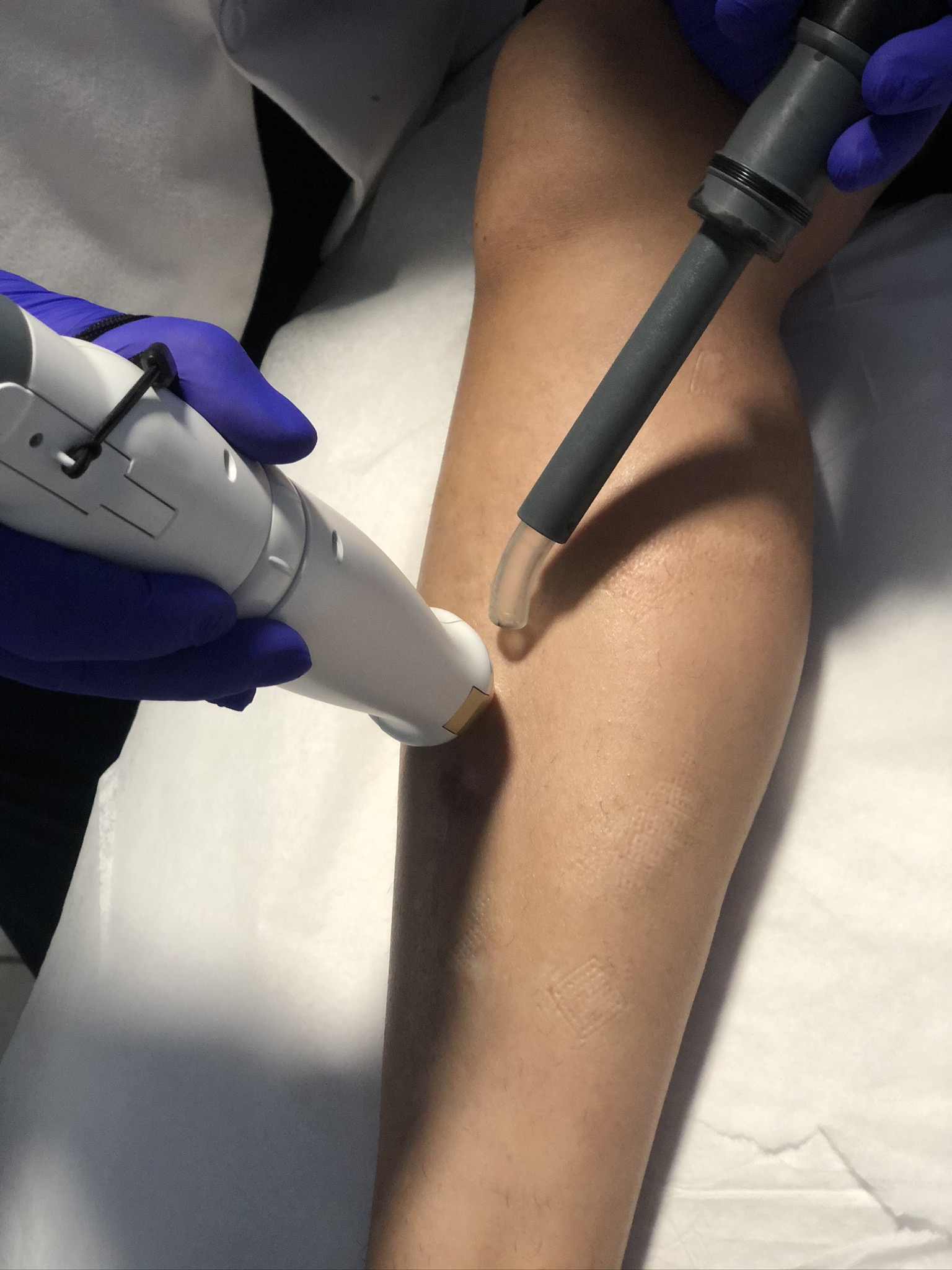 laser treatment for accident scars
