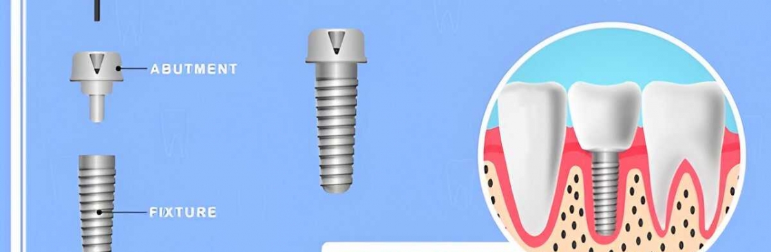 Siiodent implants Cover Image