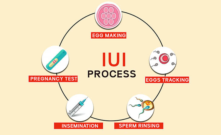 IUI Treatment Cost in Delhi, India | Dr. Rhythm Gupta