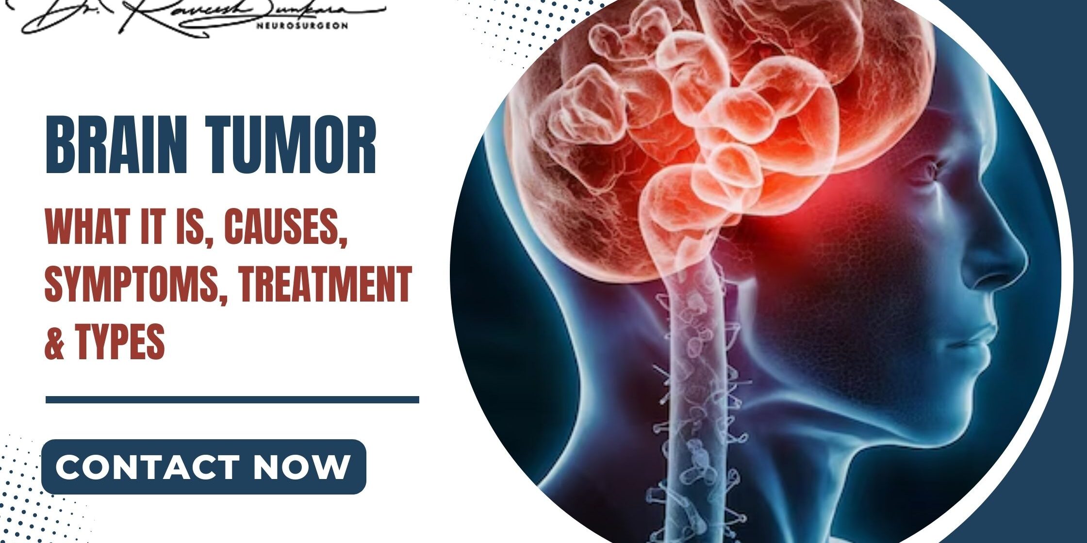 Brain Tumor: What It Is, Causes, Symptoms, Treatment & Types – Dr Raveesh Sunkara