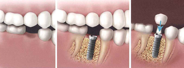 Best Dental Implants in Ambawadi Satellite | Suman Dental Care