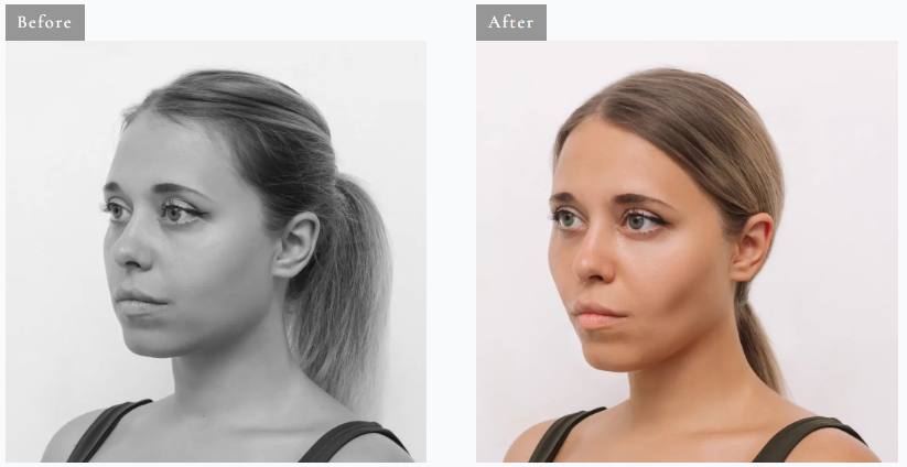 Get a Sculpted Look with Buccal Fat Pad Removal in Dublin