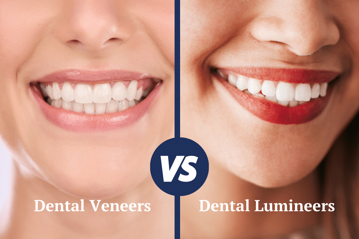 Lumineers VS Veneers: 10 key differences between Lumineers and Veneers