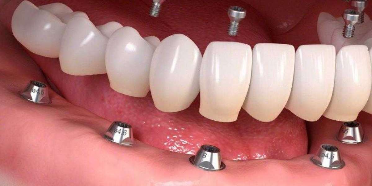Descubre el verdadero precio implantes dentales Albania y por qué es una opción inteligente